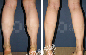 腓肠肌阻断术瘦小腿前后对比