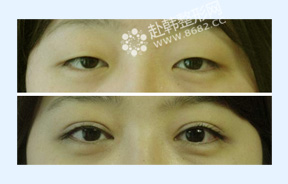 双眼皮+内眼角手术前后对比照