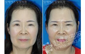 面部提升手术前后对比照