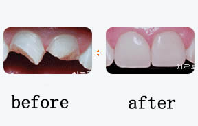 牙齿修复对比照