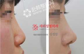 鼻尖矫正+鼻部修复前后对比照片