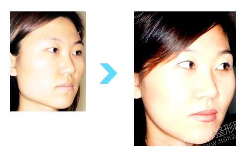 V-LINE下颌角祛除术对比照